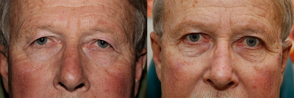 Upper Eyelid Patient 3 | Oasis Eye Face and Skin, Ashland, OR