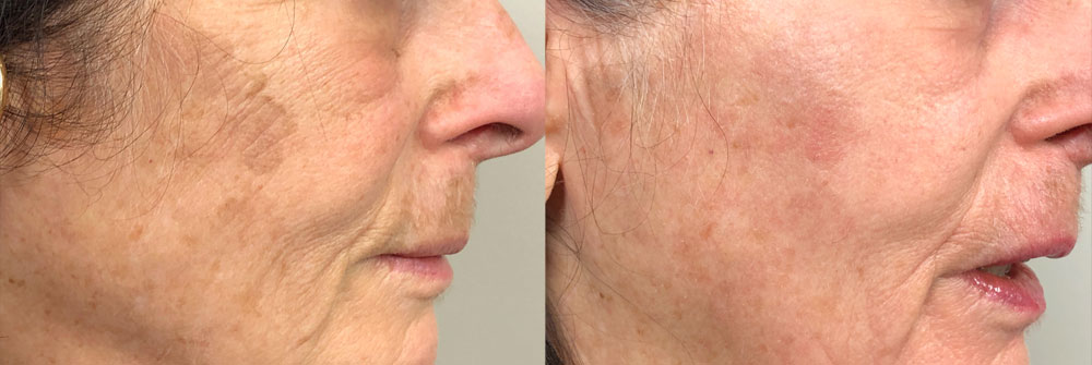 70 year old woman 30 days after Brighten Up peel improved pigmentation improved wrinkles in cheek and near mouth